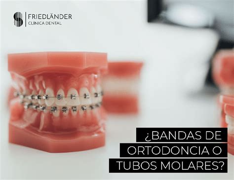 brackets bandas metalicas|bandas de ortodoncia uso.